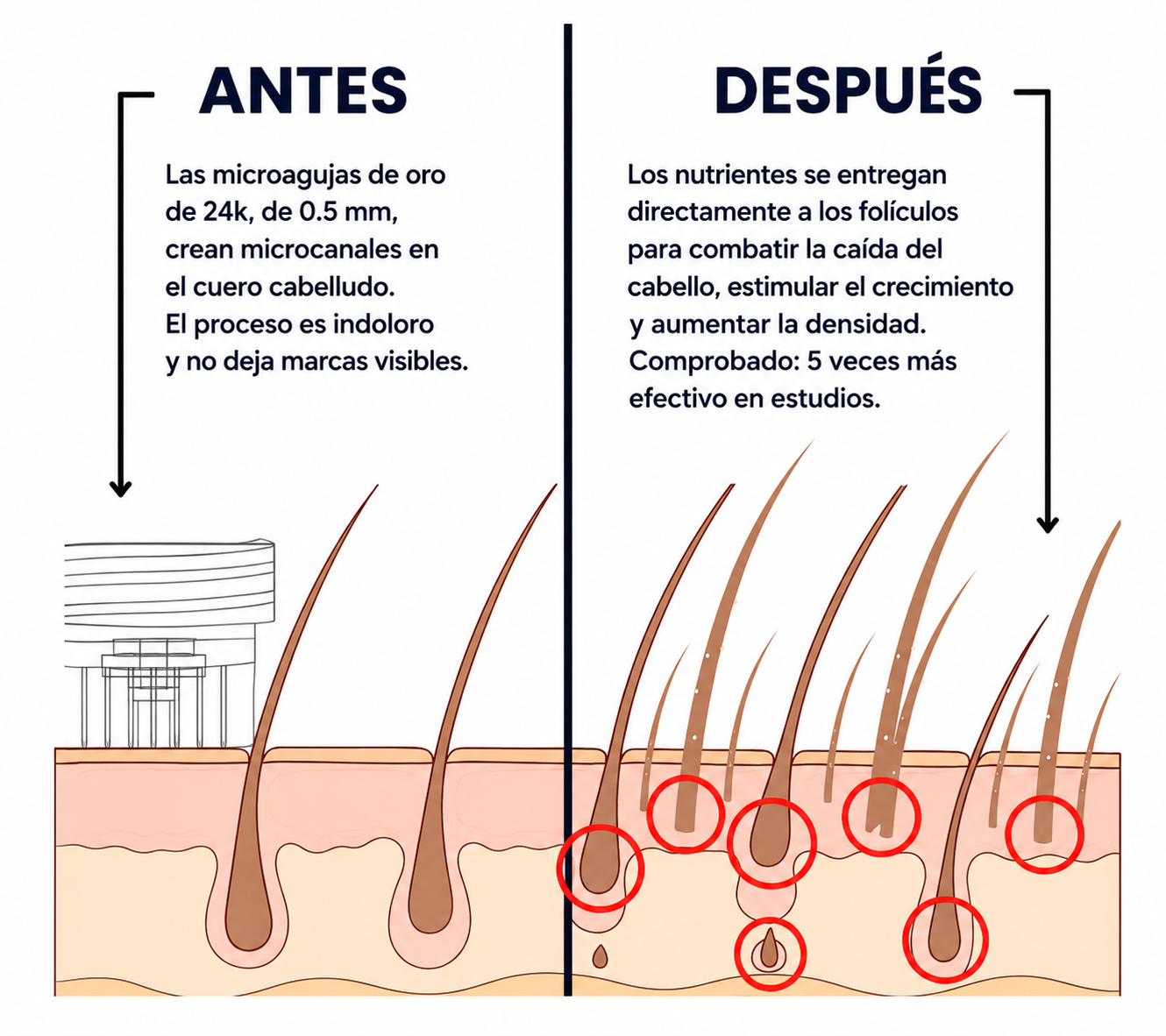 Folivia™ | Technologie de Micro-Infusion Capillaire
