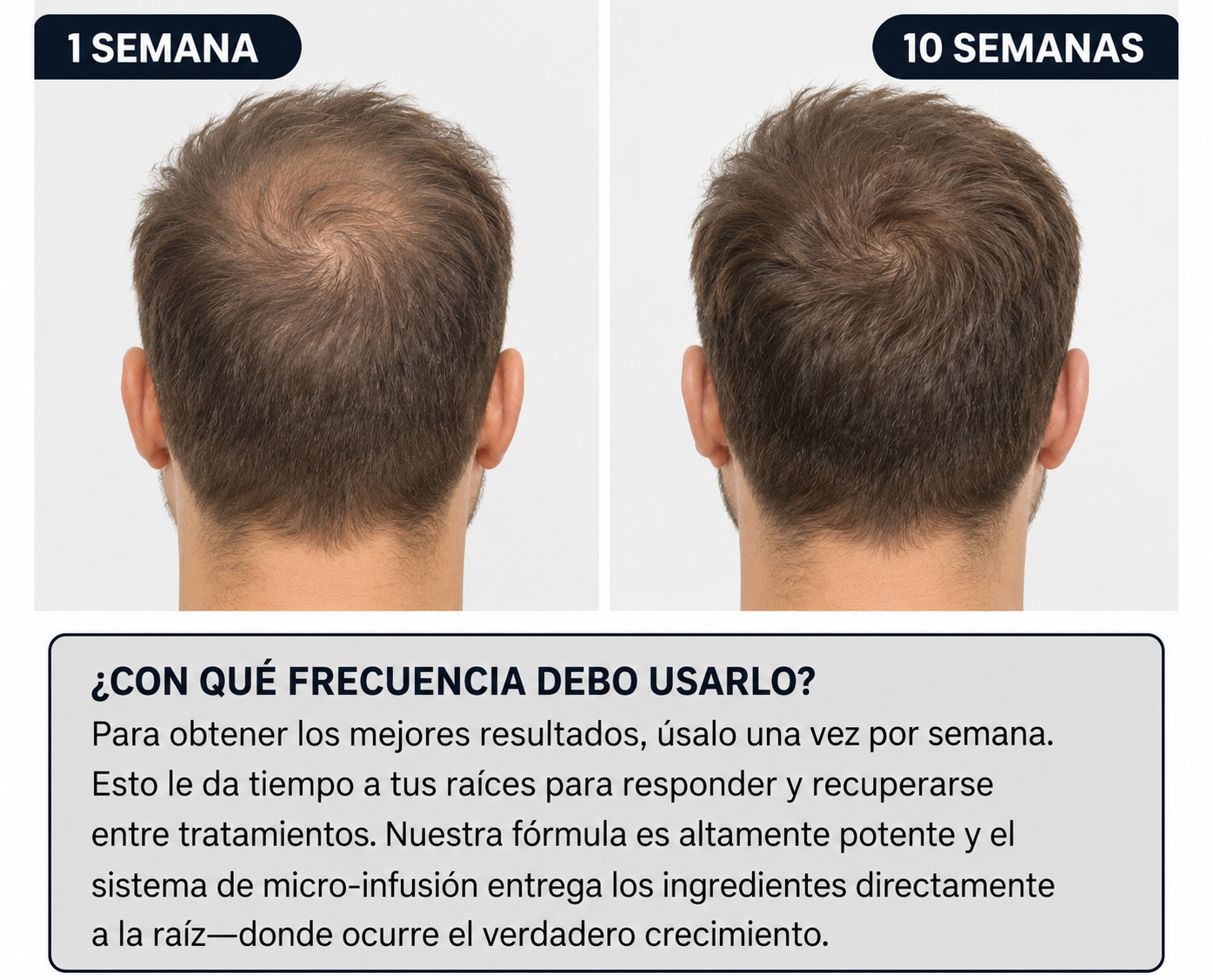Folivia™ | Technologie de Micro-Infusion Capillaire